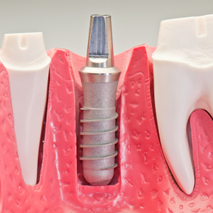 A close up of the tooth implant in its case